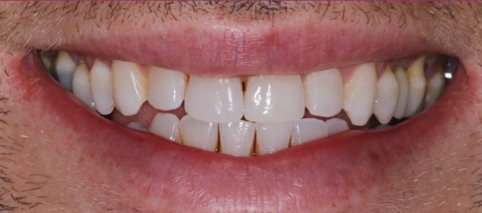 Dental implants at Heslington Dental Practice, York