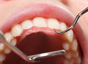 Oral cancer screening check at Heslington Dental Practice York