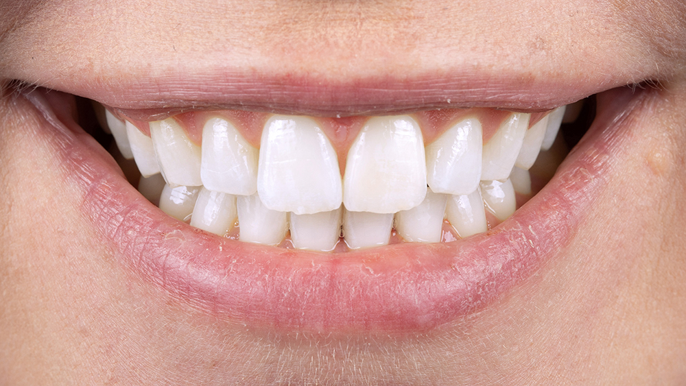 Teeth after Boutique Whitening treatment at Heslington Dental Practice York — stunning results