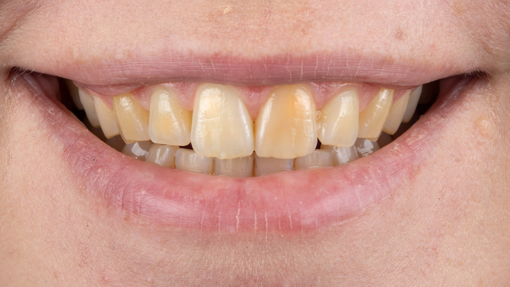 Teeth before Boutique Whitening treatment at Heslington Dental Practice York